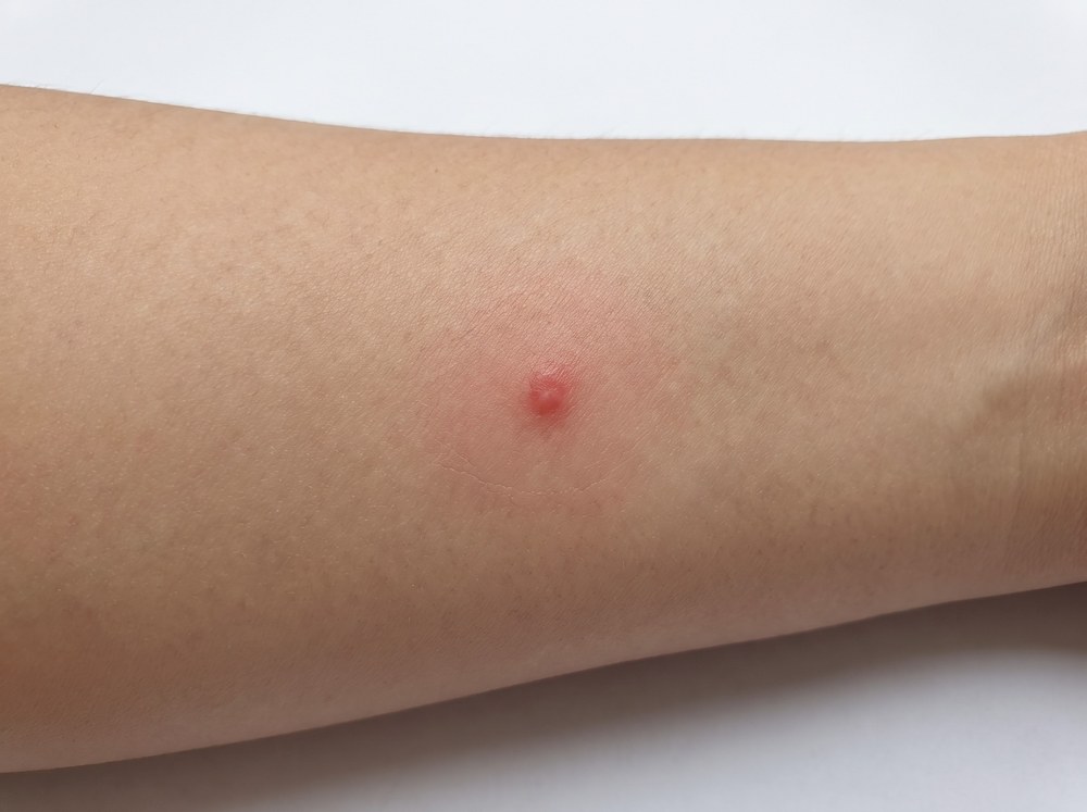 Close-up photo of a small red bite mark with mild swelling and surrounding redness on skin, consistent with a lynx spider bite